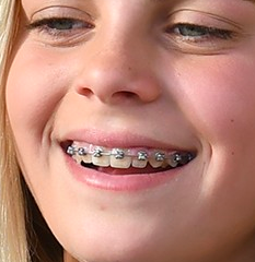 Braces