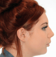 Jaw Surgery